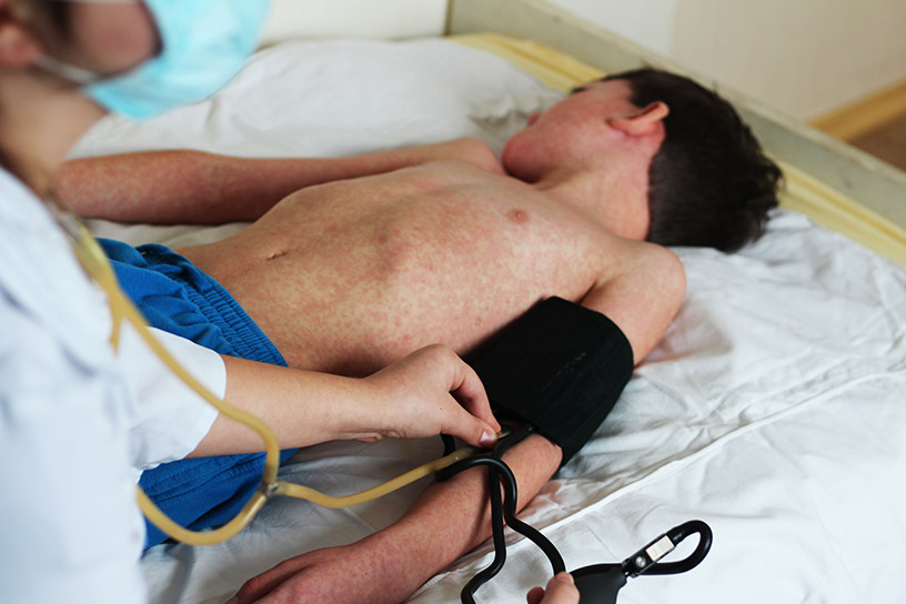 infected child with measles